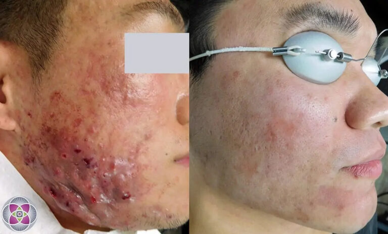 AcneBeforeAndAfter03