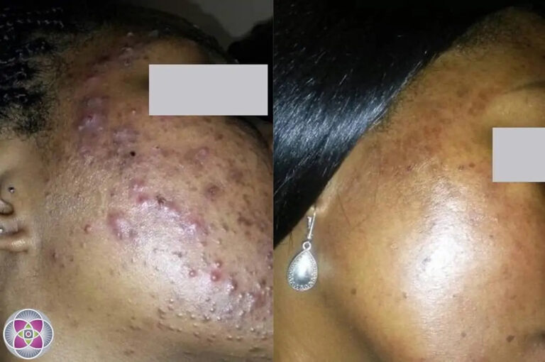 AcneBeforeAndAfter06