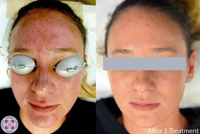 MelasmaBeforeandAfter01