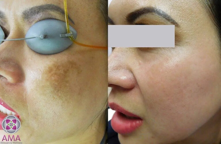 MelasmaBeforeandAfter02