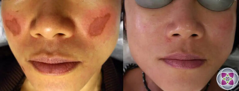 MelasmaBeforeandAfter04
