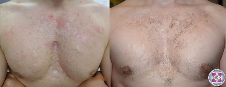 acne-scars-chest-before-and-after-lasers-subcision-stem-cells