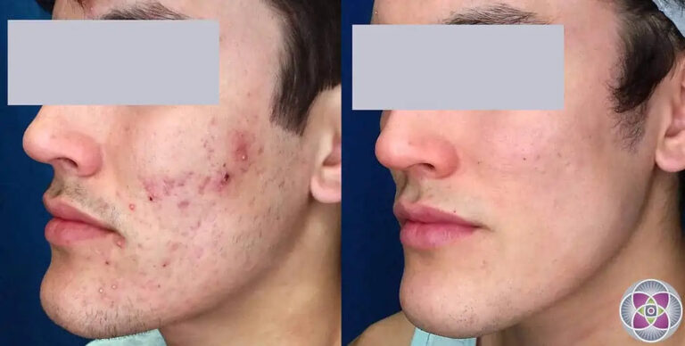 laser-cystic-acne-treatment-before-and-after-3