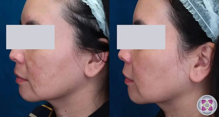 laser-treatment-for-melasma-before-and-after-13